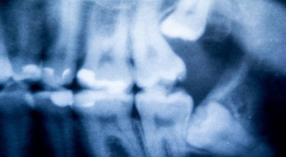 22208793 - dentist doing a dental treatment on a female patient