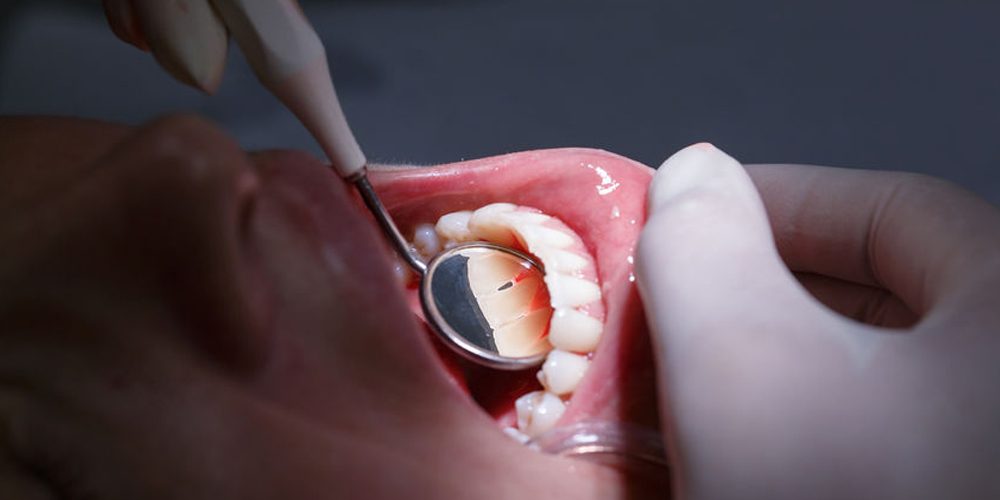 22208793 - dentist doing a dental treatment on a female patient