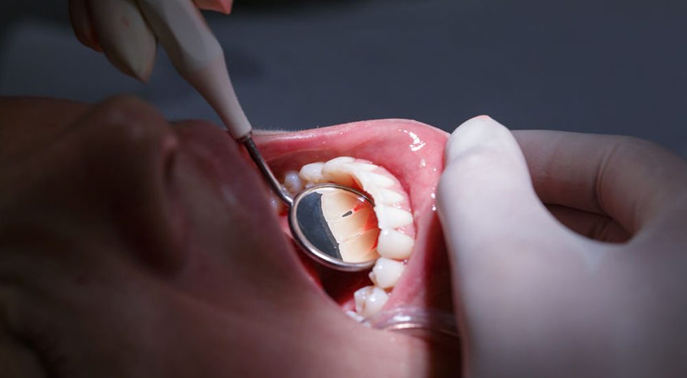 22208793 - dentist doing a dental treatment on a female patient