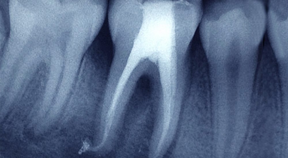 endodoncia